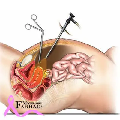 laparoscopy-hernia