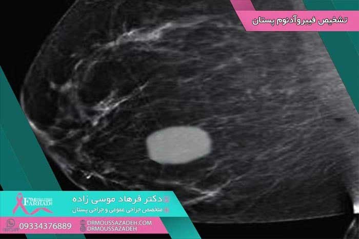 تشخیص فیبروآدنوم پستان