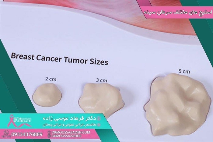 استیج های مختلف سرطان سینه