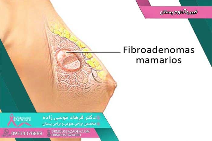 فیبروآدنوم پستان چیست