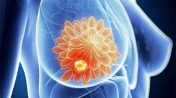توده ای سرطانی در پستان