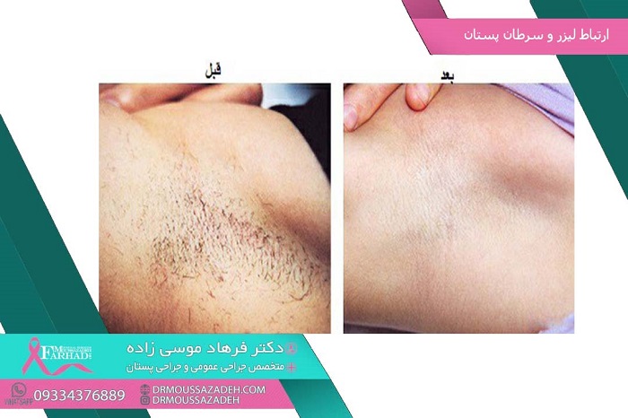 ارتباط لیزر و سرطان سینه ارتباط لیزر و سرطان سینه