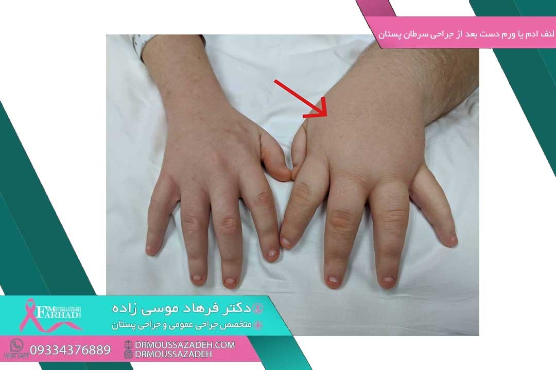 لنف ادم یا ورم دست بعد از جراحی سرطان پستان