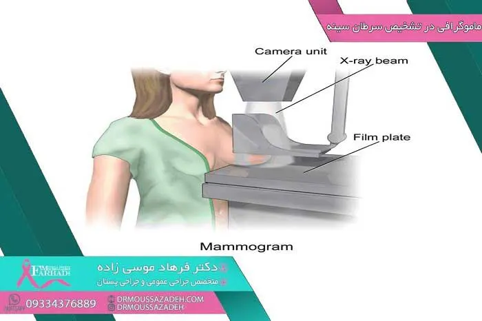 ماموگرافی-در-تشخیص-سرطان-پستان