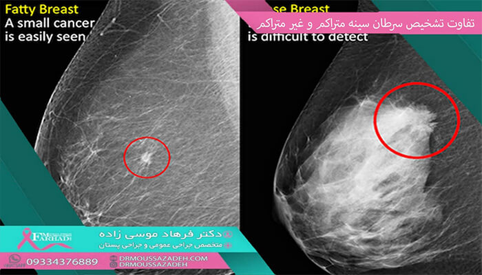 سرطان پستان در سینه متراکم
