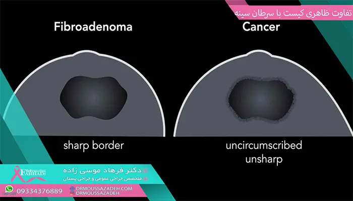 تفاوت-ظاهری-کیست-با-سرطان-سینه