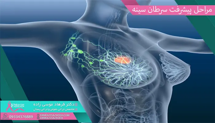 مراحل پیشرفت سرطان سینه