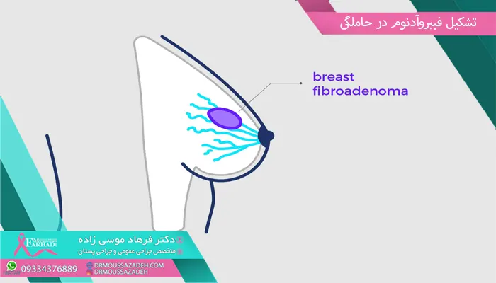 تشکیل فیبروآدنوم در حاملگی