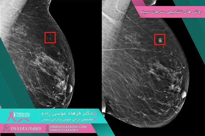 روش-های-تشخیص-سرطان-پستان عکس تومور پستان