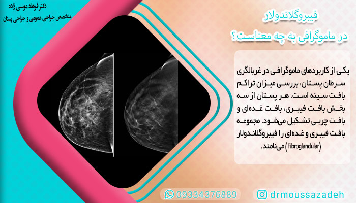 فیبروگلاندولار در ماموگرافی