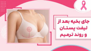 تصویر آموزشی محل برش‌های لیفت پستان و جای بخیه در روند ترمیم
